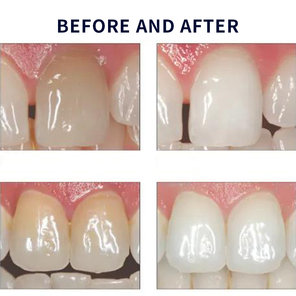 Opalescence Whitening 20% PF 2 - Teeth Whitening Kit At Home บทวิจารณ์และราคา