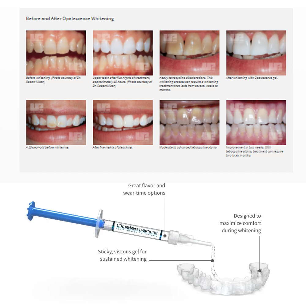 Opalescence Whitening 20% PF 2 - Teeth Whitening Kit At Home บทวิจารณ์และราคา