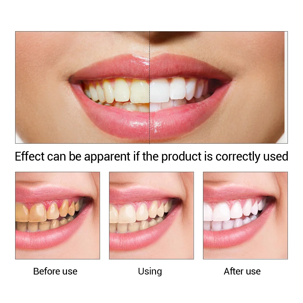 FTEENPLY Teeth Whitening Essen - Teeth Whitening (Bleaching) บทวิจารณ์และราคา