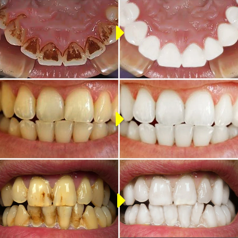 V34 Teeth Whitening Mousse Too - Teeth Whitening (Bleaching) บทวิจารณ์และราคา