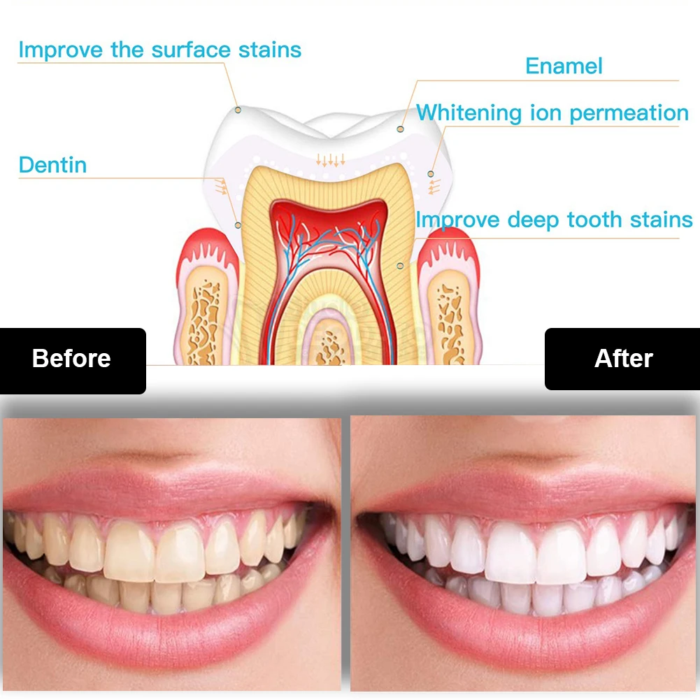 Dental Teeth Whitening Kit Min - Teeth Whitening (Bleaching) บทวิจารณ์และราคา