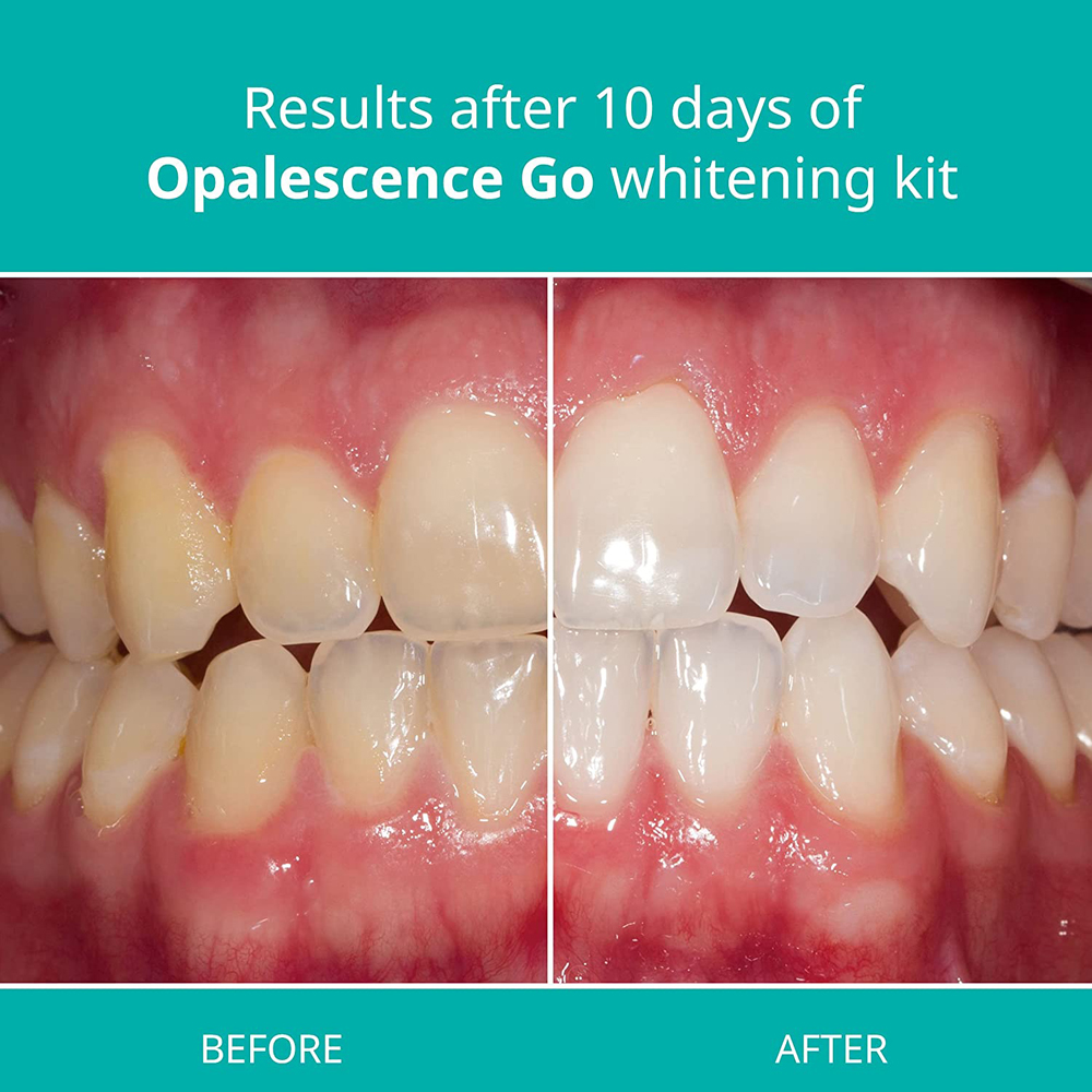 Opalescence Go Teeth Whitening - Teeth Whitening Kit At Home บทวิจารณ์และราคา